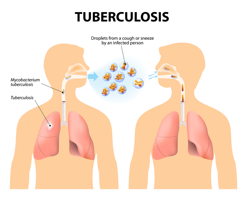 Nigeria got only 31% TB funding in 2020
