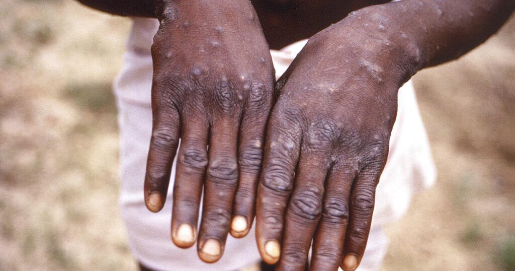 Monkeypox: 40 yearold patient dies, amid 21 suspected cases in Nigeria- NCDC