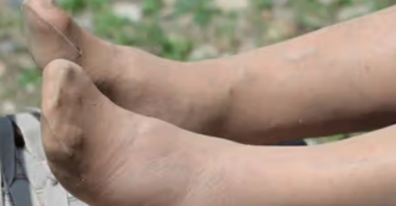 This Bladder Cancer Symptom is Overlooked by Many