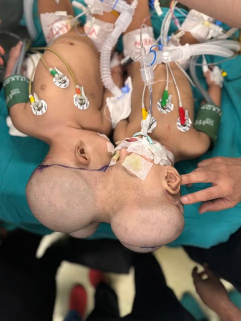 3D Technology Assists London Surgeon in Successful Separation of Conjoined Twins