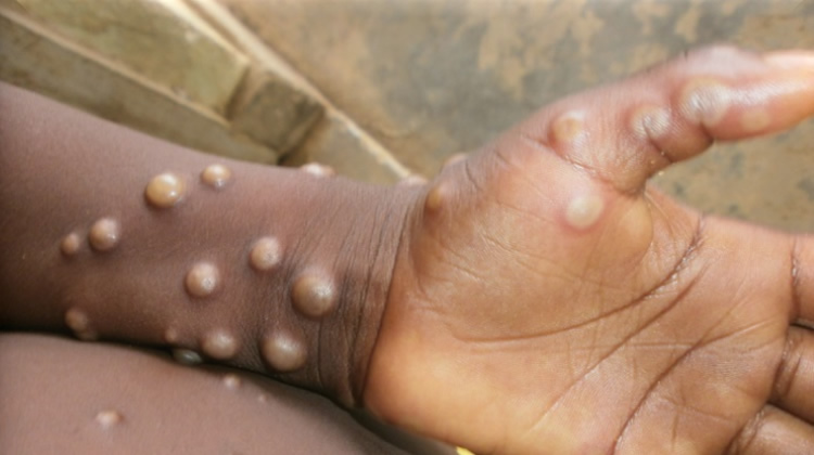 Monkeypox Outbreak in Akwa Ibom: Eight Cases Reported Across 10 Local Government Areas