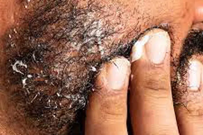 What Causes Beard Dandruff and How to Get Rid of It